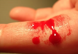 Bleeding finger