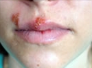 mouth with herpes