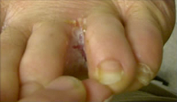 athlete's foot