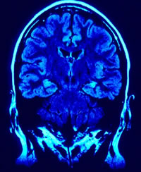 Brain MRI